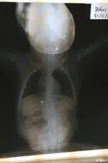 Röntgenaufnahmen von Zahris Körper, auf denen die Kugeln zu erkennen sind