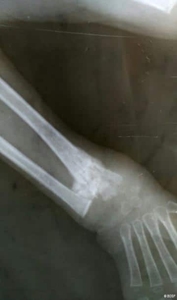  Die Röntgen-Untersuchung zeigte das gebrochene Handgelenk