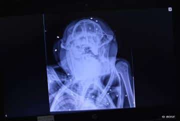 Röntgenaufnahmen von Sepats Wunden