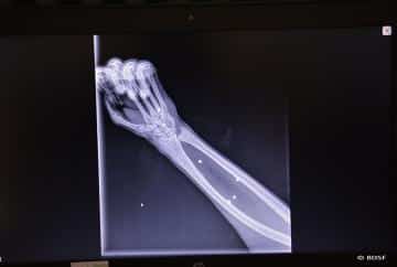 Röntgenaufnahmen von der Sepats Hand