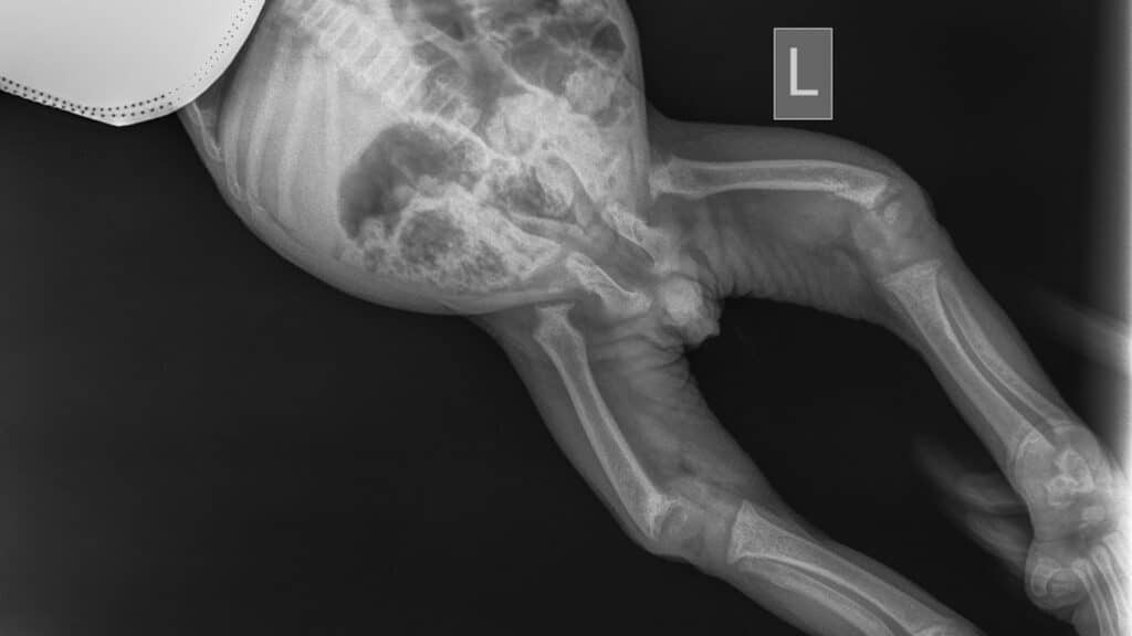 Röntenbild gebrochenes Bein von zweijährigem Orang-Utan-Jungen